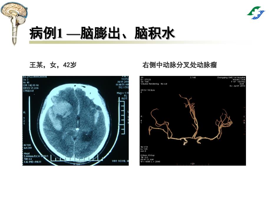 医学专题：腰大池穿刺置管引流术_第2页