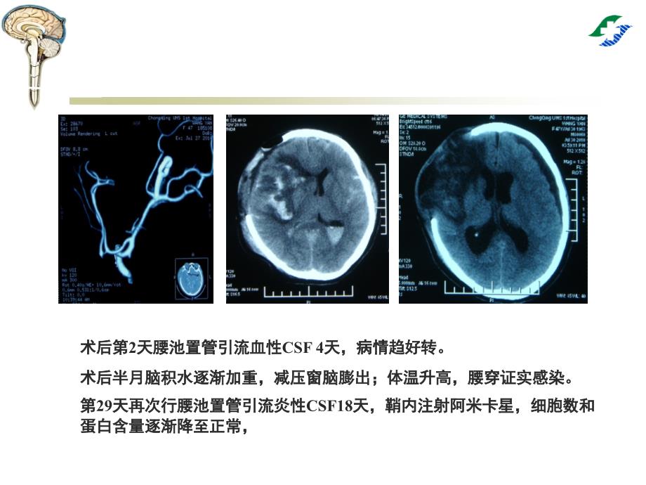 医学专题：腰大池穿刺置管引流术_第3页