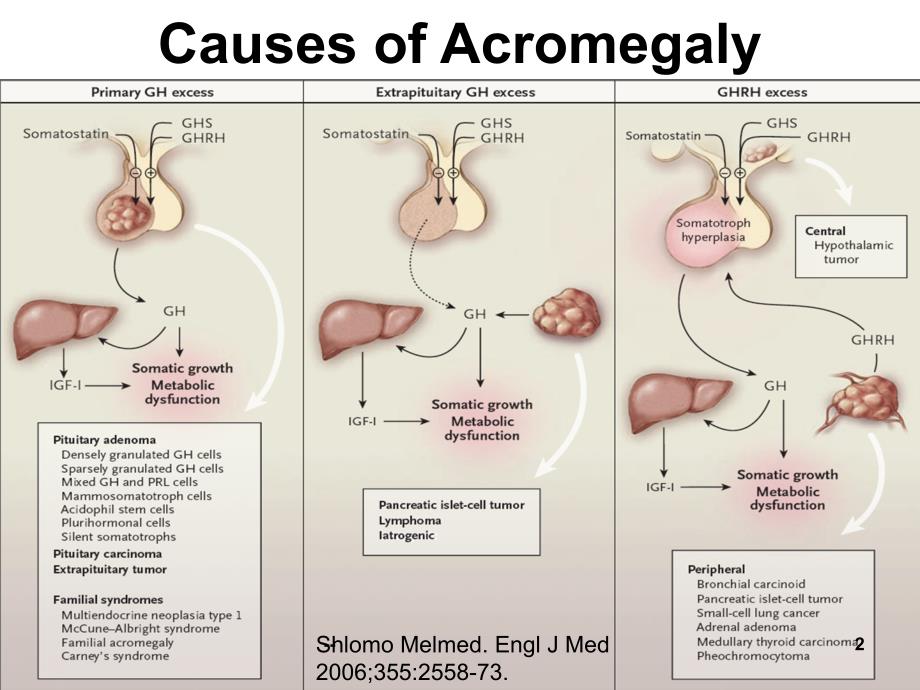 肢端肥大症诊疗新进展PPT课件_第2页