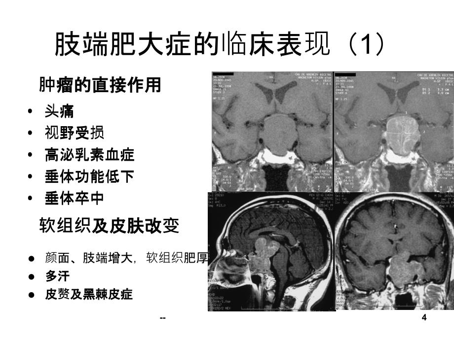 肢端肥大症诊疗新进展PPT课件_第4页