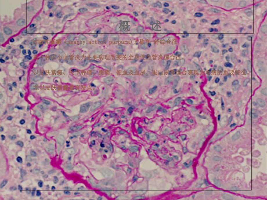 过敏性紫癜ppt_第3页