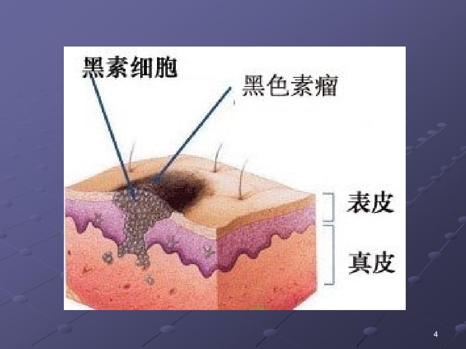 恶性黑色素瘤ppt课件_第4页