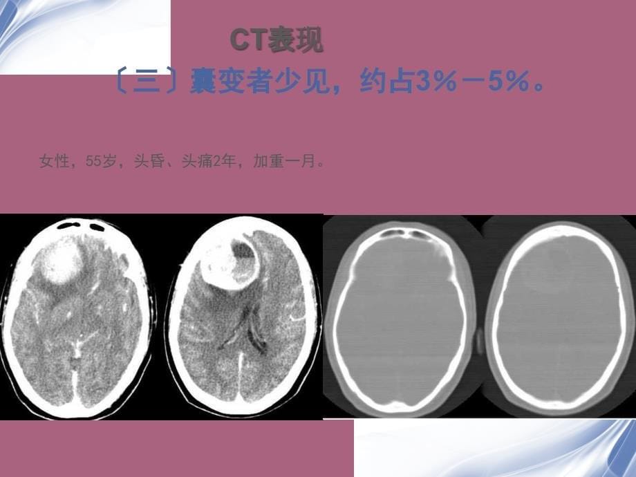 脑膜瘤ctmri表现ppt课件_第5页