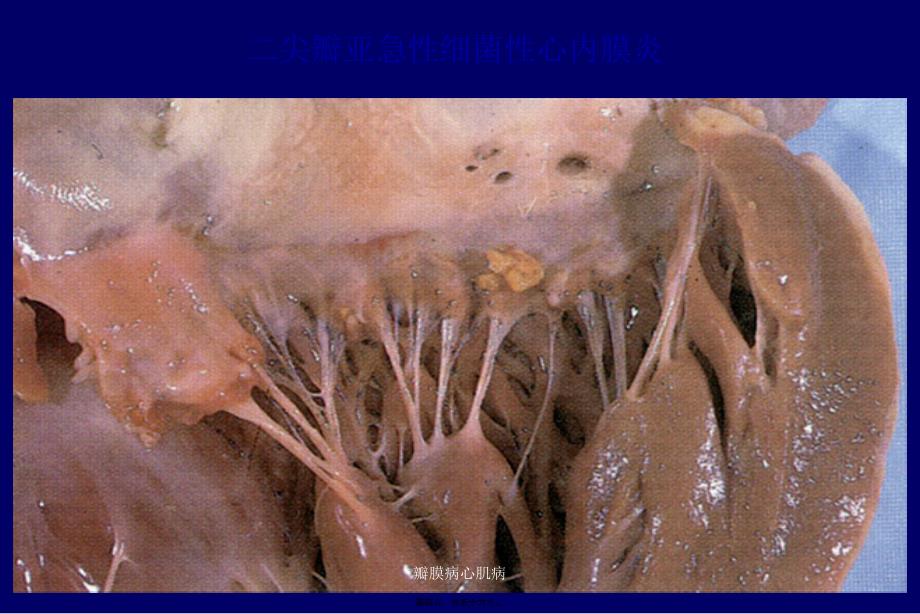 瓣膜病心肌病课件_第4页