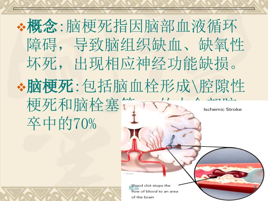 脑梗死诊断影像学治疗_第2页