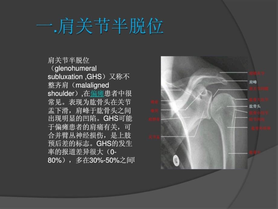 肩关节半脱位肩手综合征的康复治疗精彩_第2页