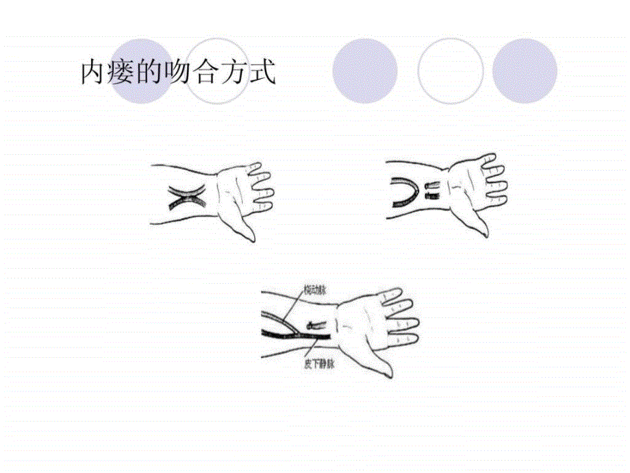 血液透析患者动静脉内瘘闭塞的原因及防护.ppt_第3页