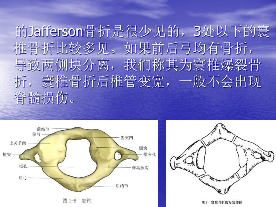 成人急性寰椎骨折循证临床诊疗指南_第3页