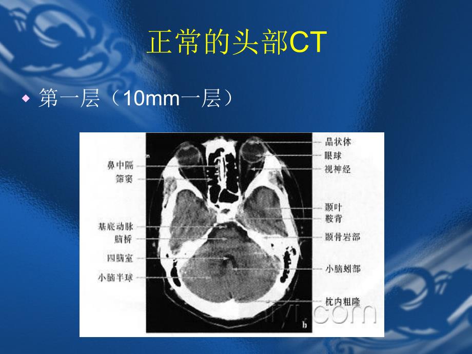 CT片的阅读技巧(头部)PP课件_第3页