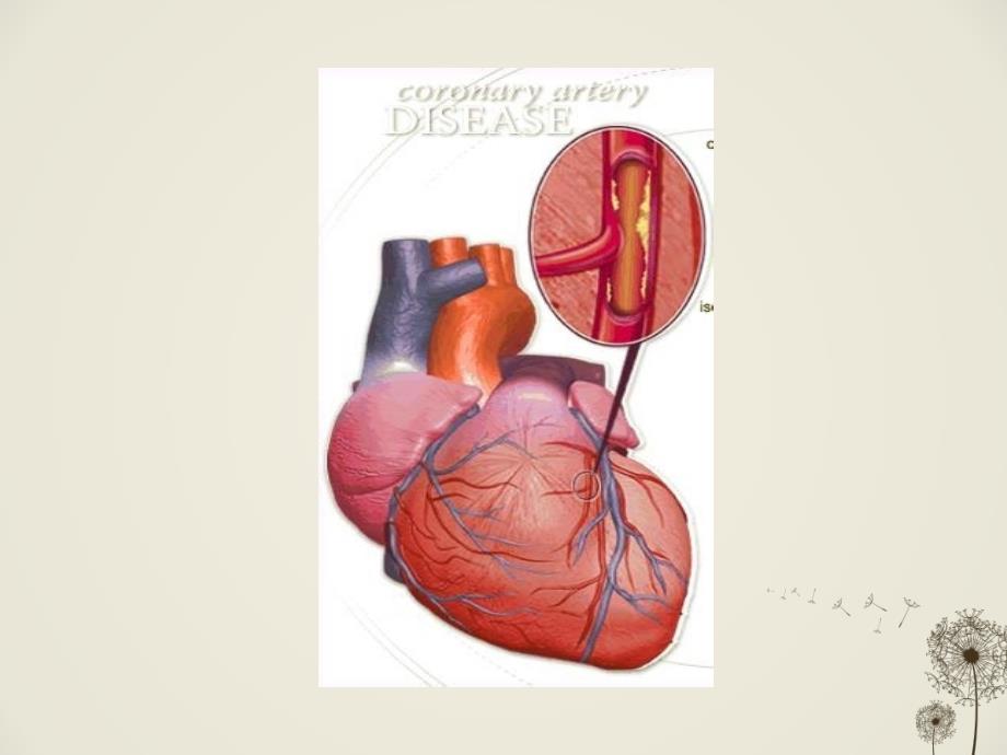 冠心病护理查房--ppt课件1_第3页