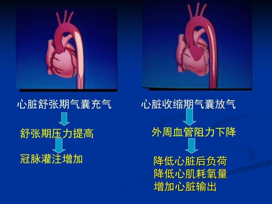 主动脉内球囊反搏的抗凝问题_第5页