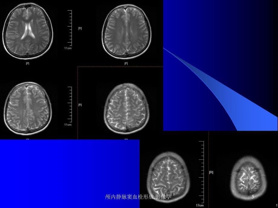 颅内静脉窦血栓形成影像学课件_第5页