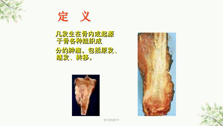 骨肿瘤医学课件_第2页