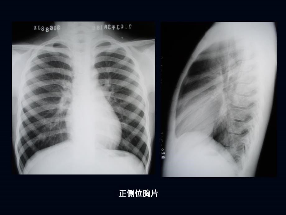 小讲座儿童胸部影像学_第5页