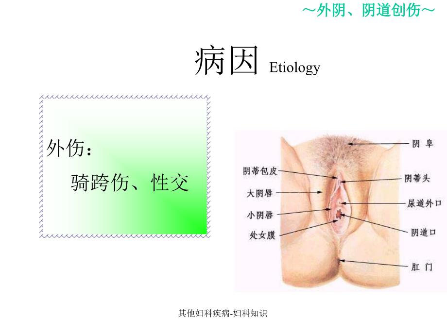 其他妇科疾病妇科知识课件_第3页