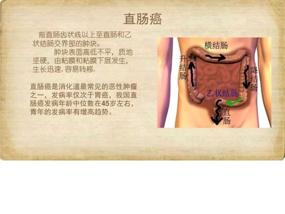 直肠癌课件_图文.名师教学资料_第2页