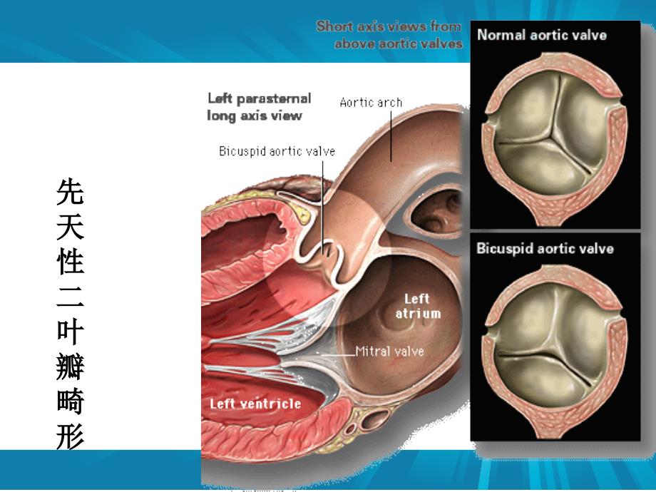 主动脉瓣疾病.ppt_第3页