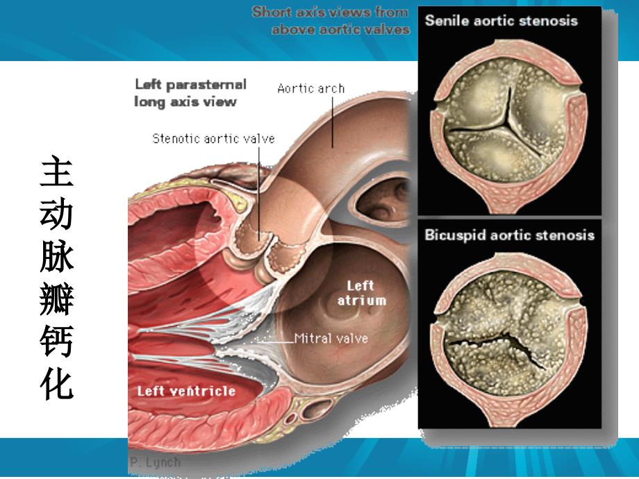 主动脉瓣疾病.ppt_第4页