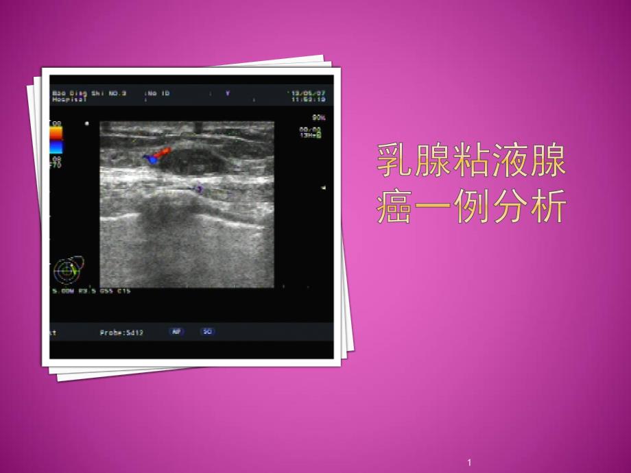 乳腺粘液腺癌一例原件PPT参考幻灯片_第1页