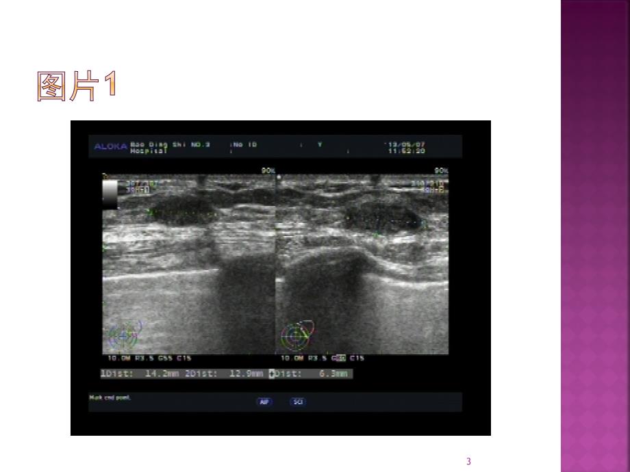 乳腺粘液腺癌一例原件PPT参考幻灯片_第3页