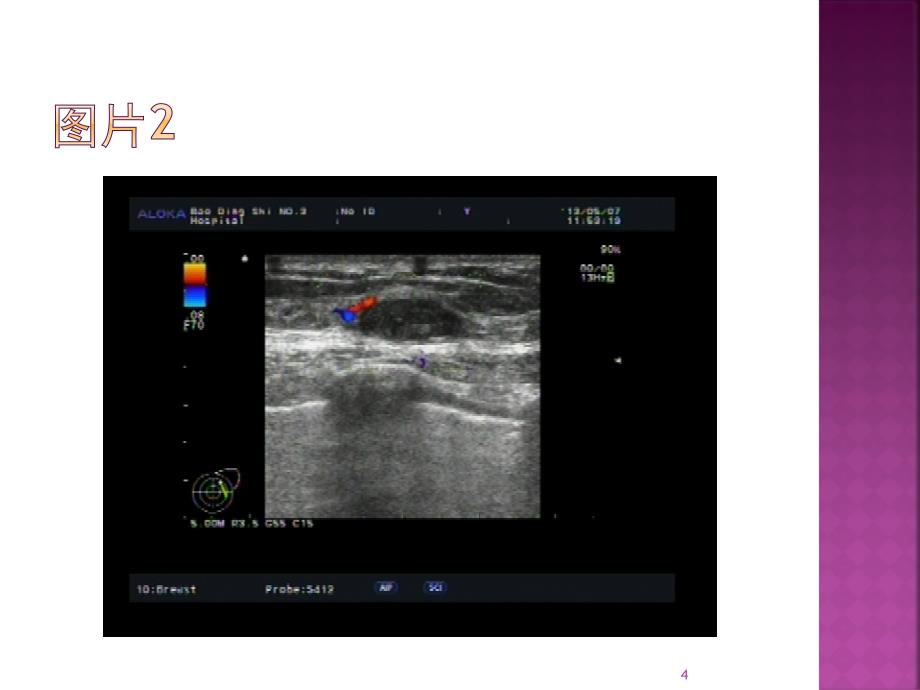 乳腺粘液腺癌一例原件PPT参考幻灯片_第4页