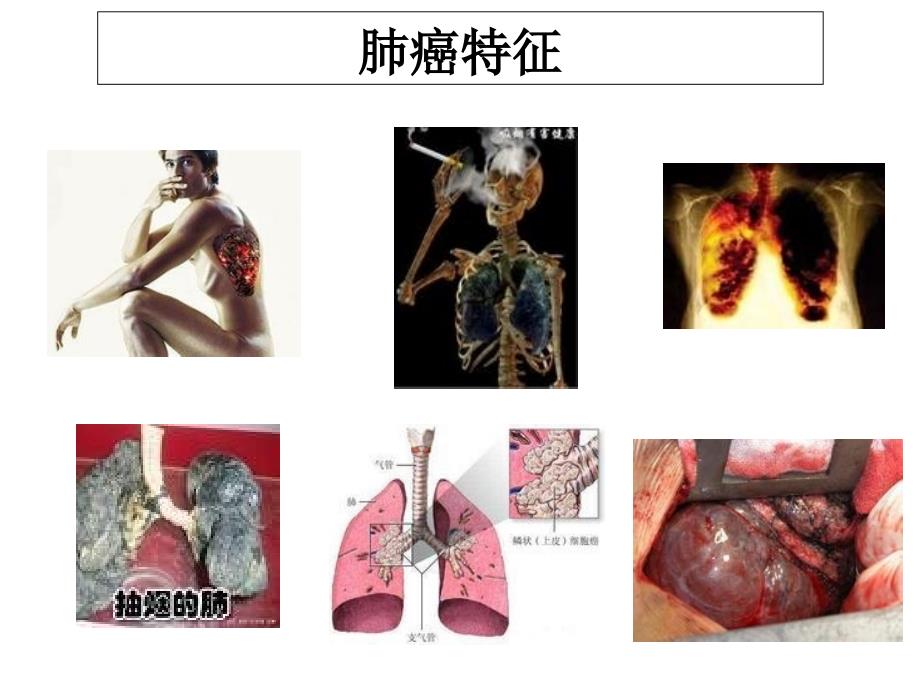 癌症的早期识别与防治_第4页