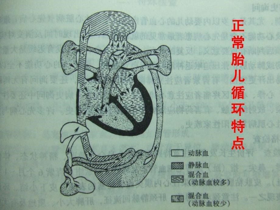 房间隔缺损、室间隔缺损_第5页