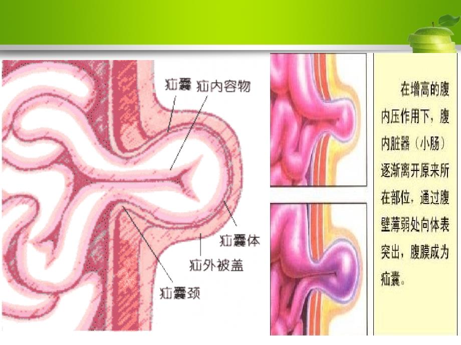 腹股沟疝患者的护理课件_第4页