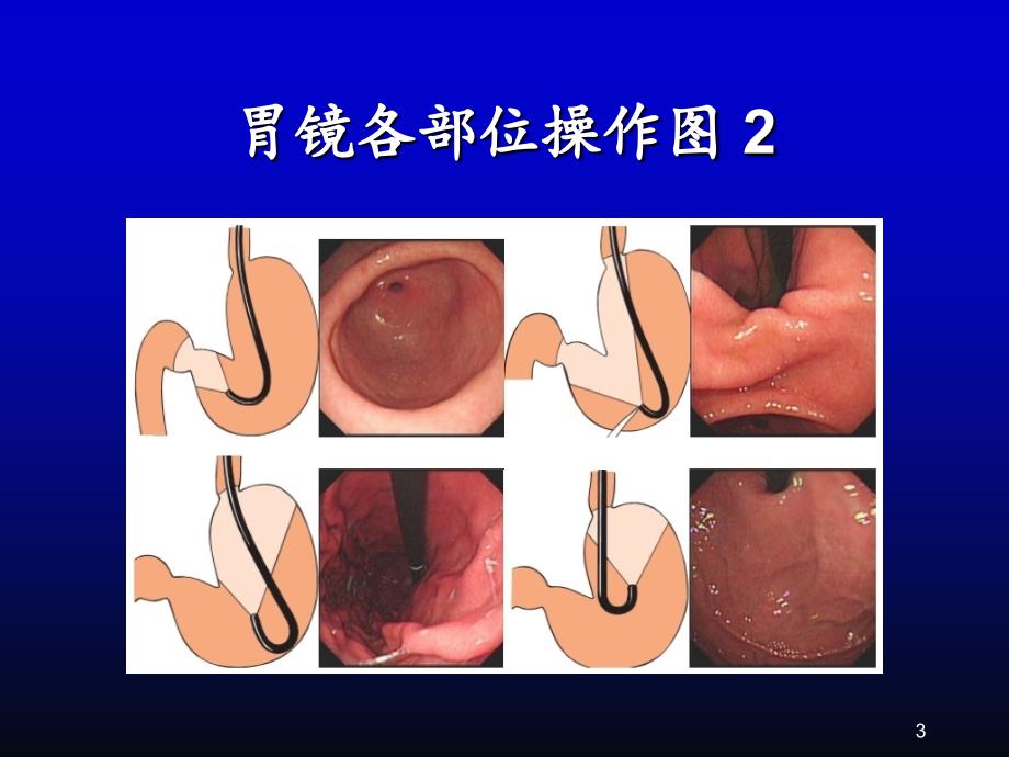 消化内镜诊疗进展ppt课件_第3页