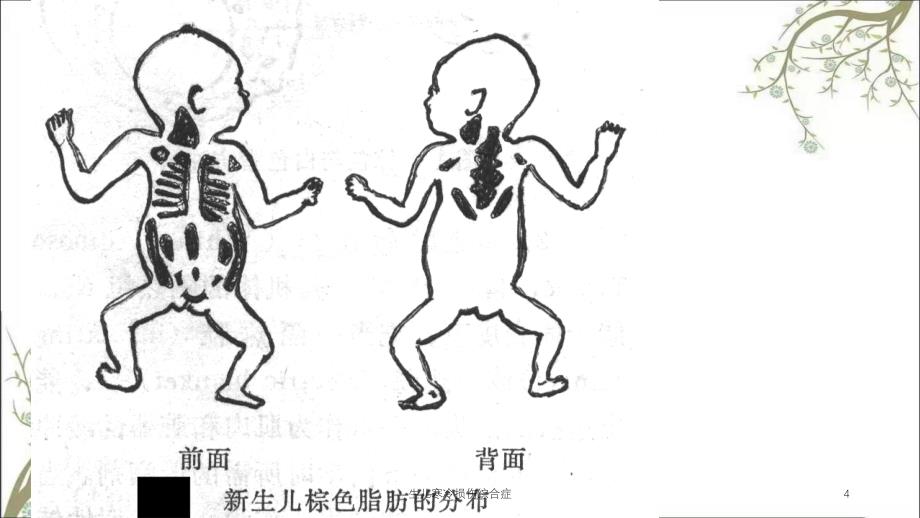 生儿寒冷损伤综合症_第4页