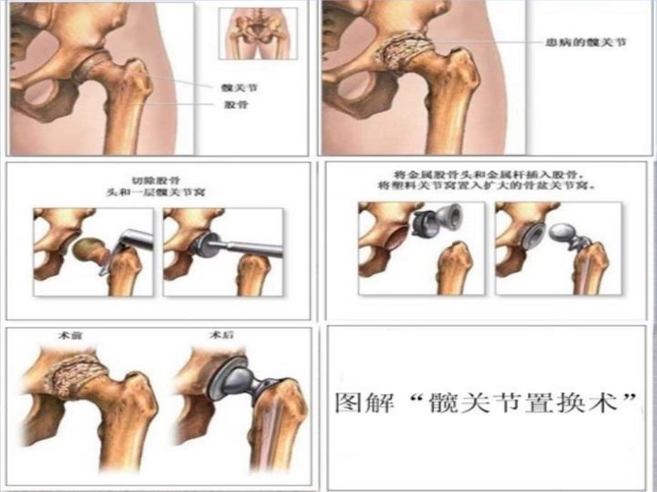 最新双侧全髋关节置换ppt课件_第3页