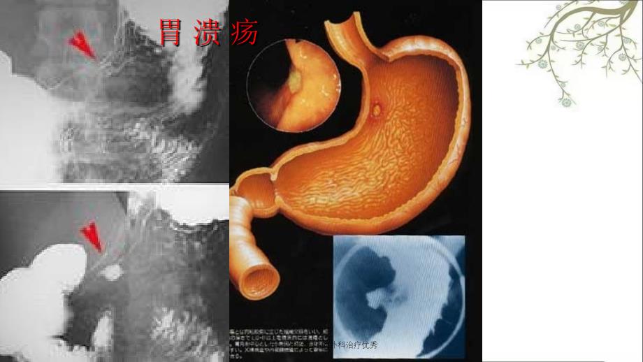 胃十二指肠溃疡的外科治疗优秀_第5页