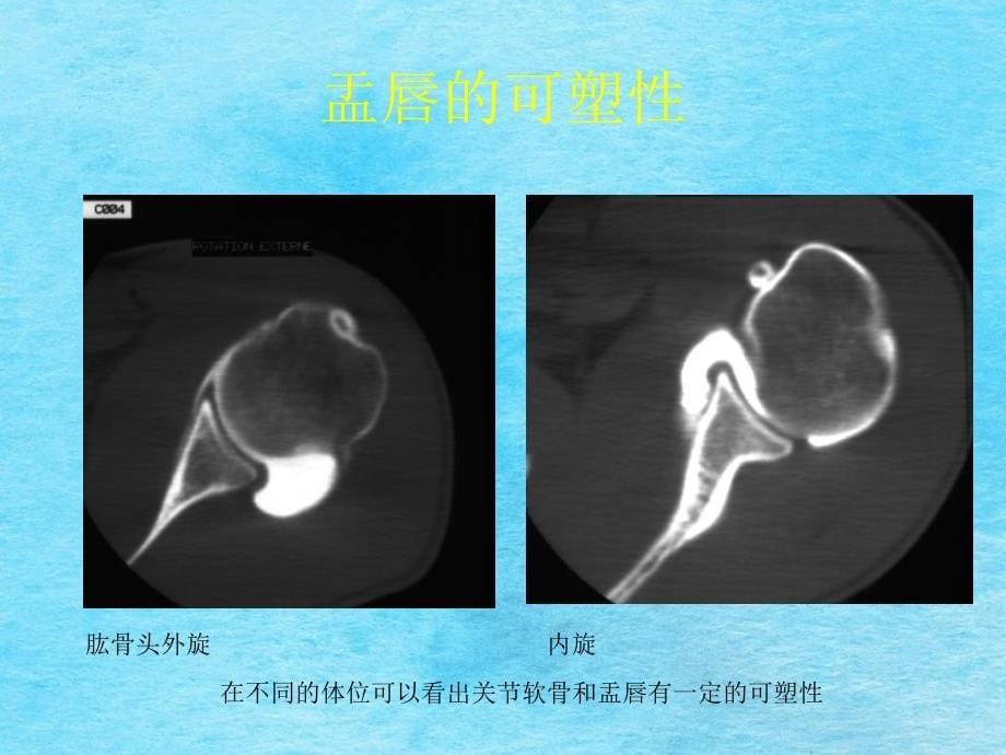 肩关节不稳定和肩袖损伤ppt课件_第5页