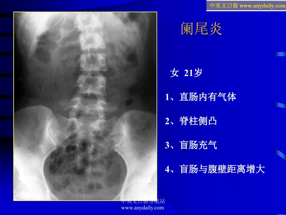 《急腹症影像诊断》PPT课件复习课程_第2页