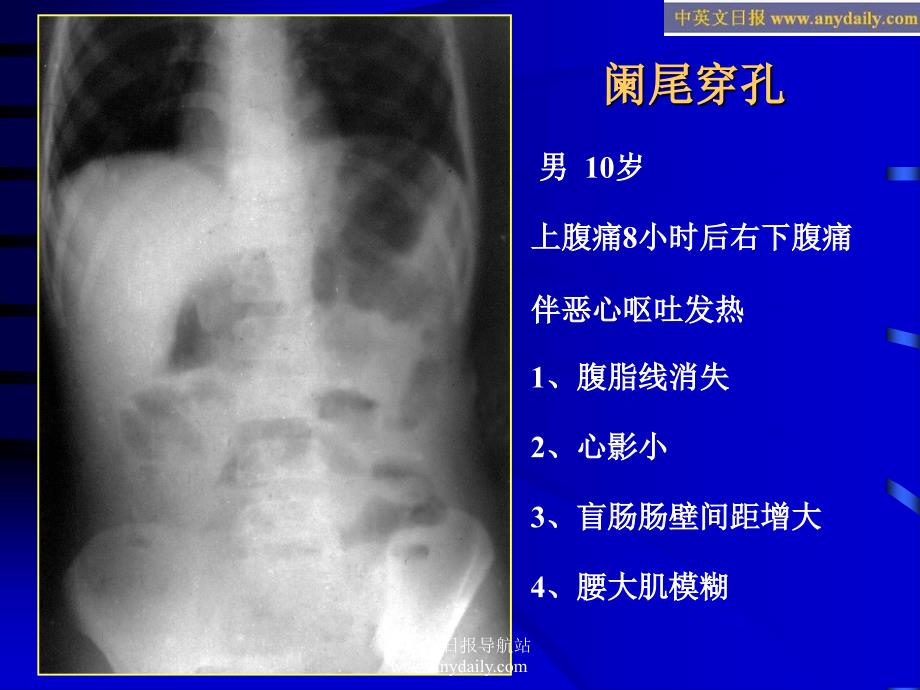 《急腹症影像诊断》PPT课件复习课程_第3页