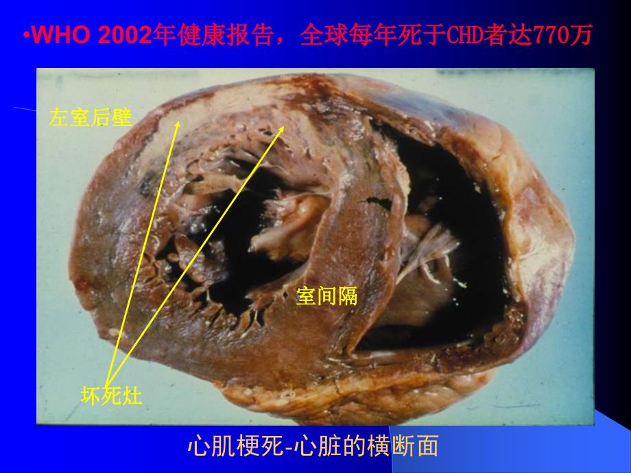 医学专题：急性冠脉综合征诊治进展_第3页