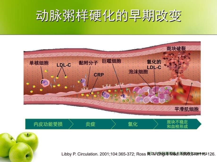 crp升高是动脉粥样硬化的因还是果何红_第5页