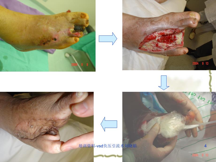 培训资料vsd负压引流术刘晓娟课件_第4页
