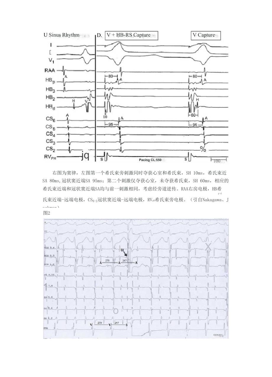 室上性心动过速鉴别诊断的常用心内电生理程序刺激方法_第3页