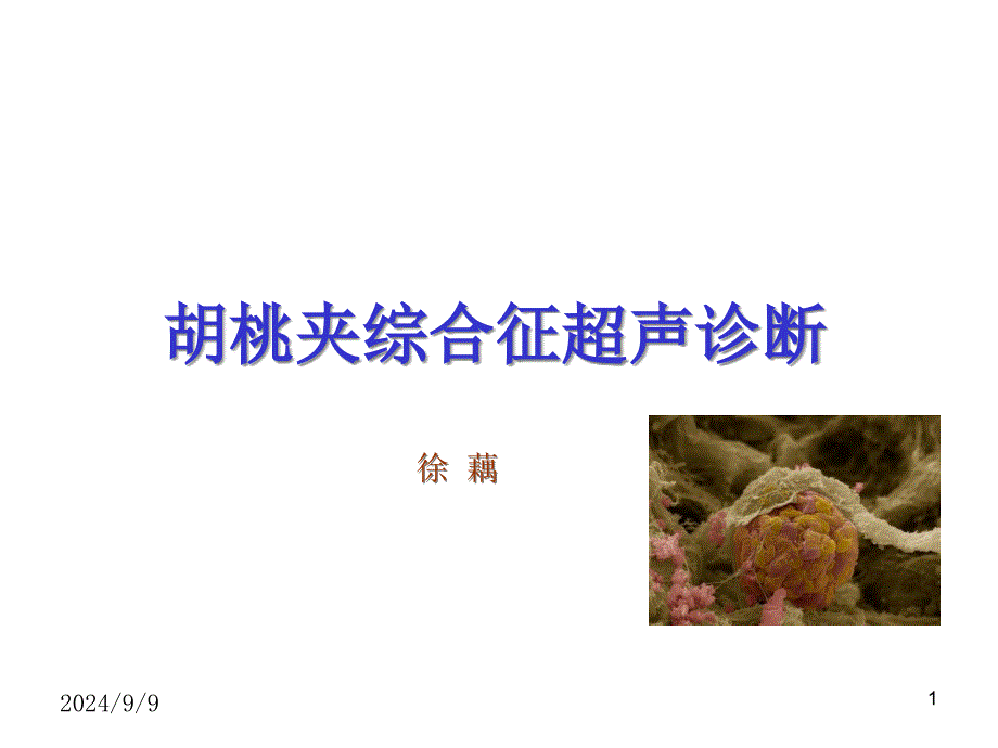 胡桃夹综合征课件_第1页