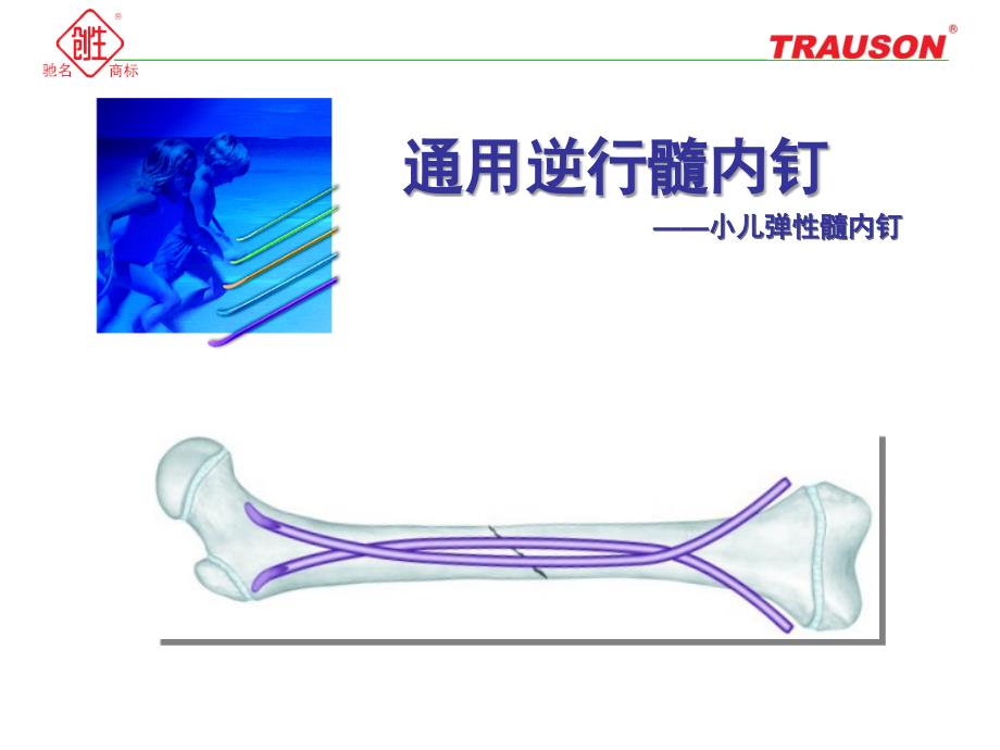 通用逆行髓内钉—小儿弹性髓内钉.ppt_第1页