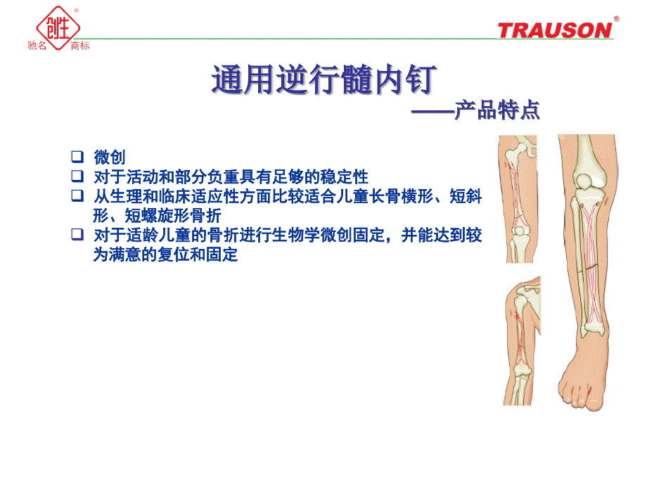 通用逆行髓内钉—小儿弹性髓内钉.ppt_第2页