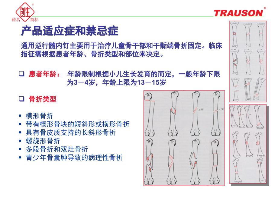 通用逆行髓内钉—小儿弹性髓内钉.ppt_第3页