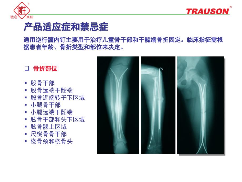 通用逆行髓内钉—小儿弹性髓内钉.ppt_第4页