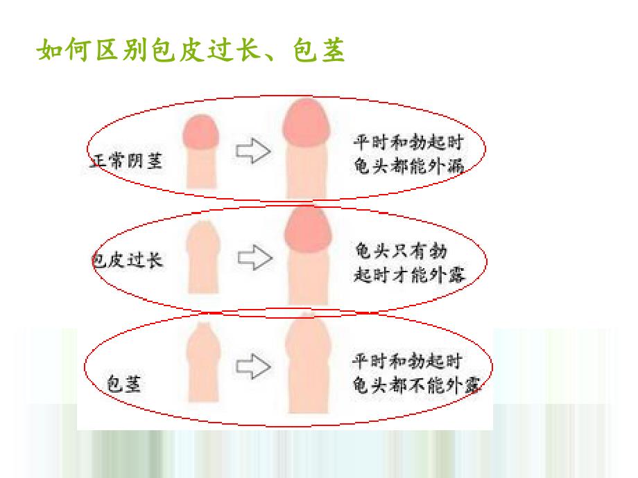 包茎、包皮过长的护理_第3页