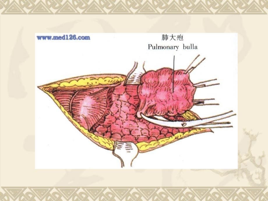 肺大疱的护理_第5页