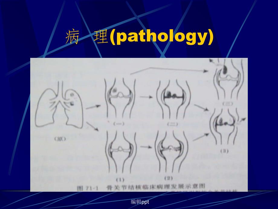 骨与关节结核杨康平_第3页