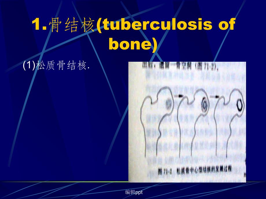 骨与关节结核杨康平_第4页