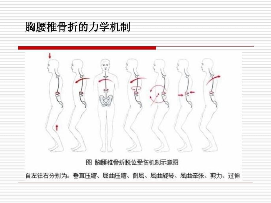 胸腰椎骨折治疗进展_第5页