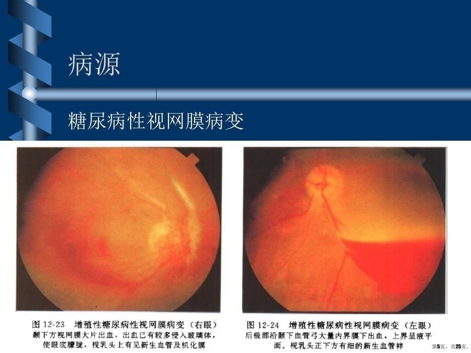 新生血管性青光眼诊断与治疗课件_第5页